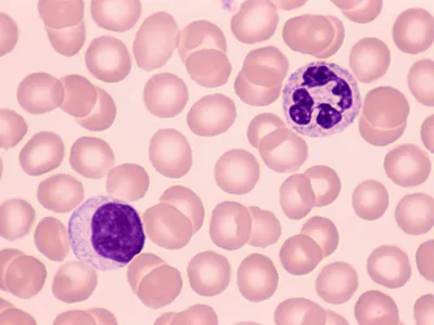 Two types of white blood cells, a neutrophil (top) and a lymphocyte (bottom), in human blood.