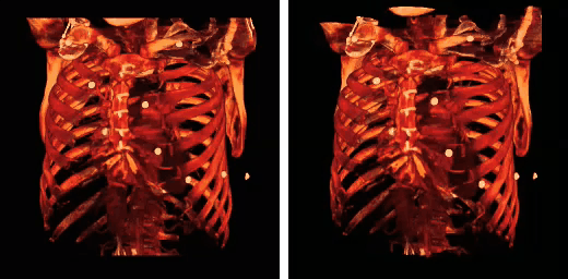 Human rib cage - CT scan (parallel projection (left) and perspective projection (right))