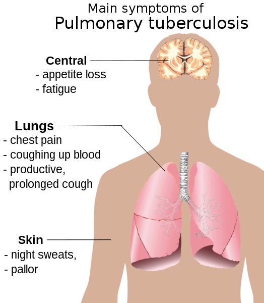 File:Pulmonary tuberculosis symptoms.svg