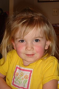 Young girl with circumoral pallor as a result of scarlet fever