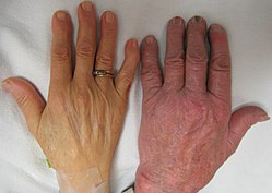 יד חיוורת של איש אנמי (משמאל) ולידה יד של אישה שאינה אנמית (מימין)