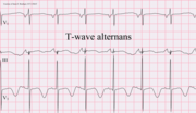 Thumbnail for T wave alternans