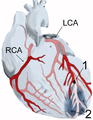 Diagrama de um infarto do miocárdio