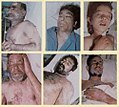 Victims of Iraq's attacks with poison gas