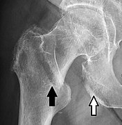 A hip fracture (black arrow) next to a skin fold (white arrow).