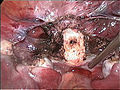 cervikální pozůstatek (bílý) po odstranění těla dělohy při laparoskopické supracervikální hysterektomii