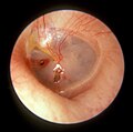 Овальний розрив лівої барабанної перетинки, у результаті удара долонню по вуху
