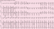 Thumbnail for Multifocal atrial tachycardia