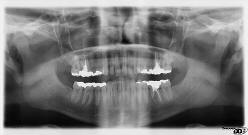 A panoramic radiograph reveals the mandible, including the heads and necks of the mandibular condyles, the coronoid processes of the mandible, as well as the nasal antrum and the maxillary sinuses.