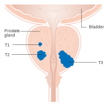 Diagram of a prostate showing a small (T1), medium (T2), and large (T3) tumor.