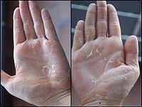 Desquamation of skin on hands, caused by scarlet fever infection