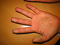 Desquamation of skin on fingertips, caused by scarlet fever