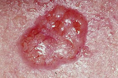 Basal cell carcinoma on patient's back