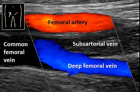 Doppler ultrasonography showing absence of flow and hyperechogenic content in a clotted femoral vein (labeled subsartorial[h]) distal to the branching point of the deep femoral vein. When compared to this clot, clots that instead obstruct the common femoral vein (proximal to this branching point) cause more severe effects due to impacting a significantly larger portion of the leg.[122]