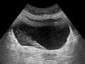 Ultrasound showing a jet of urine entering the bladder (large black section) through the ureter.
