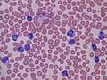 Thumbnail for Lymphocytosis