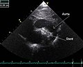 An echocardiogram of a stented persisting ductus arteriosus: One can see the aortic arch and the stent leaving. The pulmonary artery is not seen.