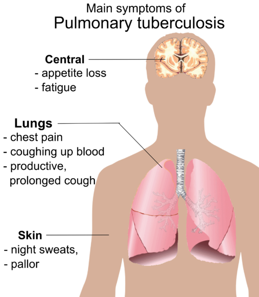 File:Pulmonary tuberculosis symptoms.png