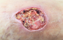 Description de l'image Úlcera varicosa (RPS 24-08-2020) en pierna con insuficiencia venosa crónica.png.