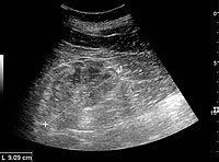 Chronic renal disease caused by glomerulonephritis with increased echogenicity and reduced cortical thickness. Measurement of kidney length on the US image is illustrated by '+' and a dashed line.[55]