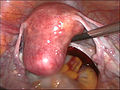 Uterus prior to hysterectomy