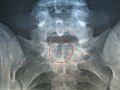 X-ray image of spina bifida occulta in S-1
