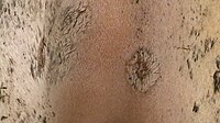 Old lesions, with regrowing hair