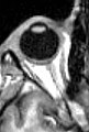 MR ljudskog oka s prikazanom lećom