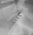 X-ray of measurement of spondylolisthesis at the lumbosacral joint, being 25% in this example