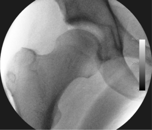 Figure 3. Fluoroscopic picture showing a mild amount of distraction of the hip before insertion of any instruments