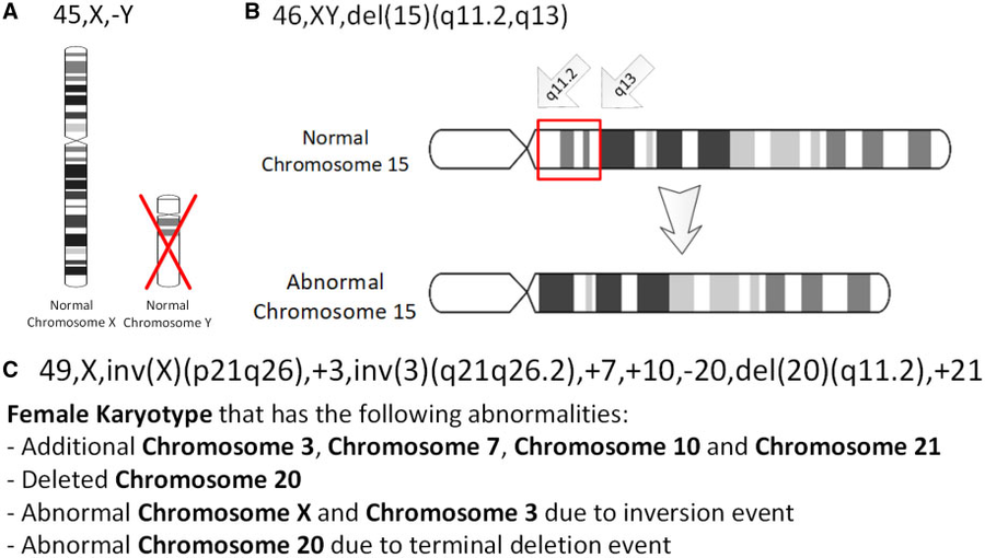 Three chromosomal abnormalities with ISCN nomenclature, with increasing complexity: (A) A tumour karyotype in a male with loss of the Y chromosome, (B) Prader–Willi Syndrome i.e. deletion in the 15q11-q12 region and (C) an arbitrary karyotype that involves a variety of autosomal and allosomal abnormalities.[23]
