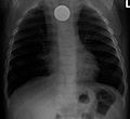 A coin seen on AP CXR in the esophagus