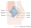 Diagram showing the area removed with an anterior operation