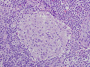 Granuloma without necrosis in a lymph node of a person with sarcoidosis