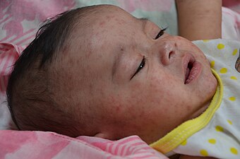A Filipino baby with measles