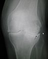 Primary osteoarthritis of the left knee. Note the osteophytes, narrowing of the joint space (arrow), and increased subchondral bone density (arrow).