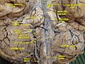 Cerebrum. Inferior view. Deep dissection.