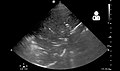 Pneumonia seen by ultrasound[76]