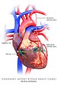 Coronary artery bypass graft, triple bypass
