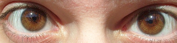 A light brown iris is most common in North Africa, Eastern Europe, the Americas and West Asia
