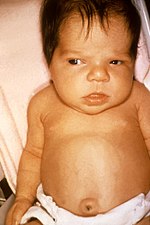 Thumbnail for Congenital hypothyroidism
