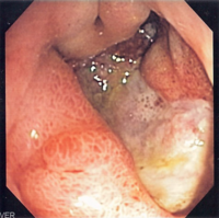Deep gastric ulcer