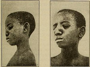 Goundu, a very rare yaws-caused deformity around the nose