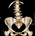 Congenital block vertebra of the lumbar spine. CT volume rendering.