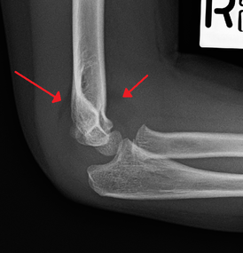 Anterior and posterior sail sign in a child who has a subtle supracondylar fracture
