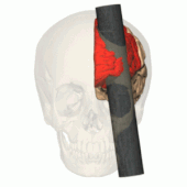 A diagram of Gage's skull