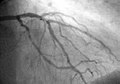 A coronary angiogram that shows the LMCA, LAD, and LCX