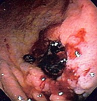 Gastric ulcer in antrum of stomach with overlying clot due to gastric lymphoma.