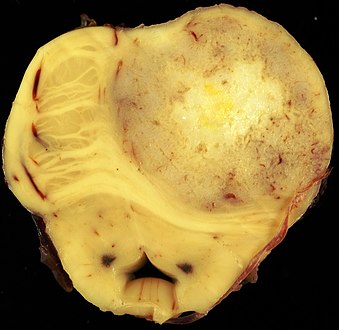A pathological specimen of a gemistocytic astrocytoma