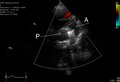 An echocardiogram of a coiled PDA: One can see the aortic arch, the pulmonary artery, and the coil between them.